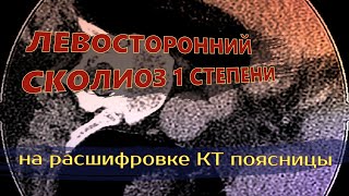 ЛЕВОСТОРОННИЙ СКОЛИОЗ поясничного отдела 1 степени и ГРЫЖА l4 l5 l5 s1 на РАСШИФРОВКЕ КТ поясницы [upl. by Tim782]