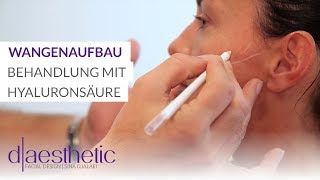 Wangenaufbau  Behandlung mit Hyaluronsäure  daesthetic [upl. by Ker845]