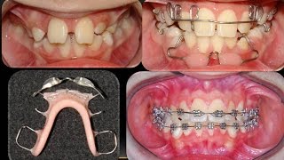 Removable Orthodontic Appliances Orthodontist [upl. by Sisxela]