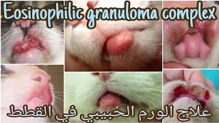 What are Granulomas  Pathology mini tutorial [upl. by Leiso]