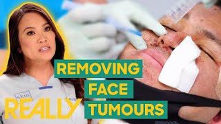 Dr Lee’s Patient Endures Uncomfortable Face Tumour Removal  Dr Pimple Popper Pop Ups [upl. by Aratnahs]