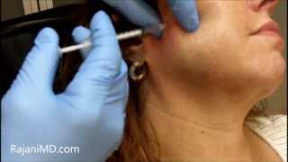 Watch Botox Facial Shaping and TMJRajani [upl. by Hrutkay]