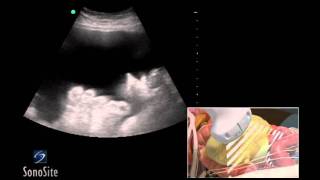 How To Ultrasound Guided Paracentesis Procedure 3D Video [upl. by Aleen]