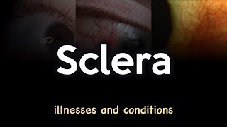 Sclera Illnesses and Conditions [upl. by Odlavu]