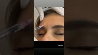 wrinkle face botox treatment [upl. by Ecargyram]