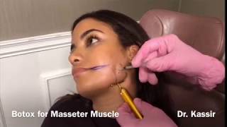 Botox for Masseter Muscle [upl. by Yelkcub]