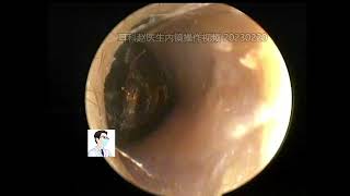 Ear wax removal Hard like rock CERUMEN20230220 [upl. by Timon140]