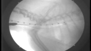 Primary Tracheal Collapse6DAY29Stent Placement under fluoroscopy [upl. by Timmie]