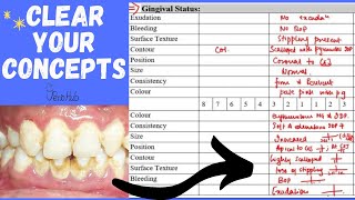 Examination Of The Gingival Status ‖ Health VS Gingival Disease ‖ Gingival Considerations ‖ PerioHub [upl. by Paten]