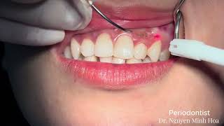 Gingival Depigmentation Gum Bleaching  Gum Lightening Treatment SIROLaser Blue [upl. by Airdnaz148]