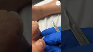 Tip of Toe Callus Removal [upl. by Etireugram]