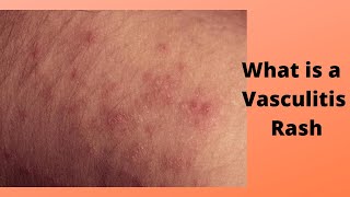 What is a Vasculitis Rash [upl. by Nwad]