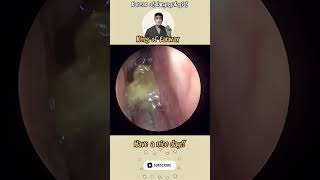 귀지형 콧물 부비동염 축농증 비염 코청소 이비인후과 rhinorrhea rhinitis sinusitis asmr ENT ENTdoctor [upl. by Ylrehc321]