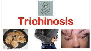 Trichinosis Pork Parasite  Pathophysiology Signs amp Symptoms Diagnosis Treatment [upl. by Emmye]