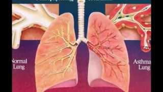 Pathophysiology of asthma [upl. by Nathaniel485]