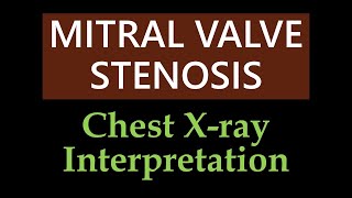 Mitral Valve Stenosis  Chest Xray Interpretation [upl. by Llertnor]