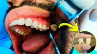 Extração de 2 dentes do Siso em 2 minutos  Procedimento Completo [upl. by Elagiba]