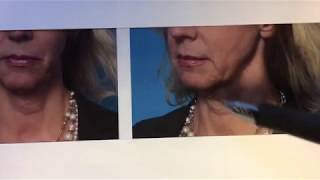 Lower Facelift  Lifting the Face and Neck  Before and After  Dr Anthony Youn [upl. by Malliw]