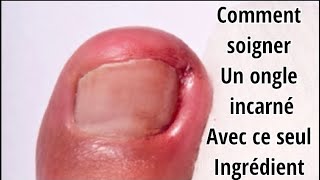 Comment soigner un ongle incarné naturellement [upl. by Dong]