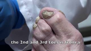 No Nail Nipper The Truth is the Sander The Doc Part 1 [upl. by Nonnarb]