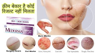 Mederma Cream अच्छी नहीं है😡Skin काली हो रही है कोई फायदा नहीं मिलता Mederma Cream Result in Hindi [upl. by Cerelia]