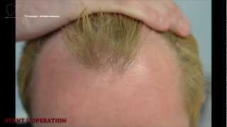 FUE 2207 Ufs MeDiKemos Hair Transplantation FR [upl. by Bluhm]