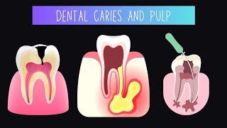 Dental caries and pulp [upl. by Aibara563]