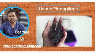 Lichen planopilaris  बालों का permanent गंजापन  Scarring vs Nonscarring Alopecia alopecia bald [upl. by Aurelea532]