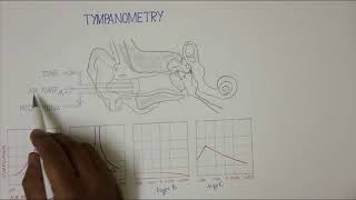 TYMPANOMETRY [upl. by Atnauqal]