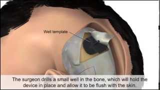 Cochlear Implant [upl. by Winfield389]