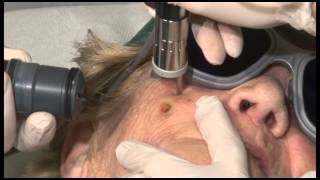 Synchro VasQ Facial Wart Treatment [upl. by Ramat]