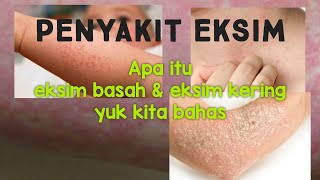 Dermatitis atopikeksim peradangan pada kulit menyebabkan rasa gatal yang hebat [upl. by Meeki81]