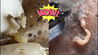 Ultimate Pimple Popping Compilation  Extreme Acne Treatment  Satisfying Blackhead Removal [upl. by Greenland]