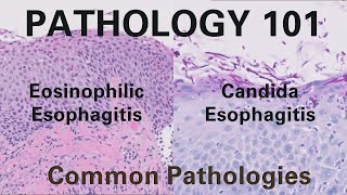 Eosinophilic Esophagitis amp Candida Esophagitis  Pathology 101 GI Pathology [upl. by Anirdnaxela]