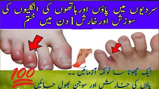 Feet Swelling Treatment Paon ki Sojan Ka ilaj  Chilblains treatment at home  Home Remedies [upl. by Enneillij]