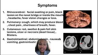 Mucormycosis  The fungal Infaction [upl. by Enyluqcaj15]