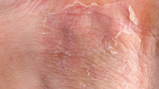 Eczema GRAPHIC Fast Outbreak Treatment Options  Eczema Dermatitis Rash Treatment 2015 [upl. by Modeste354]