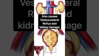 Posterior Urethral Valves [upl. by Ruosnam256]