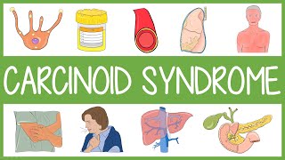 Carcinoid Syndrome in 3 Minutes [upl. by Sweatt]