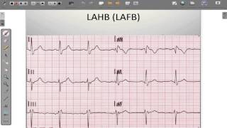 ECG 12 Lead Conduction System Abnormalities [upl. by Jamnis]