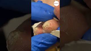 Tip of Toe Callus Removal by Podiatrist [upl. by Soule]