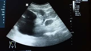 Hydronephrosis and hydroureter ultrasound examination [upl. by Dinny207]