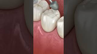 Dental Restoration Composite Bonding Teeth 3D Medical Animation asmr animation shorts trending [upl. by Lezlie]