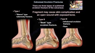 Calcaneal Avulsion Fractures  Everything You Need To Know  Dr Nabil Ebraheim [upl. by Eilesor]