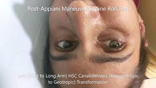 Transformation of Apogeotropic Horizontal Canal BPPV to Geotropic Variant [upl. by Ateekan695]