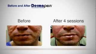 MicroNeedling Before and After  Dermapen® Treatment [upl. by Gavrilla]