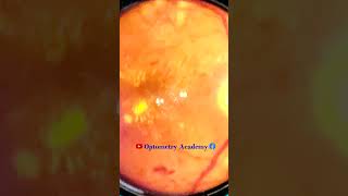 Diabetic retinopathy  Hemorrhages  cotton wool spots  Hard exudates  Fundus  Short Video 128 [upl. by Hatfield399]