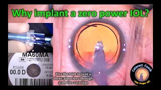 Why implant a zero power IOL in very myopic cataract surgery [upl. by Retniw]