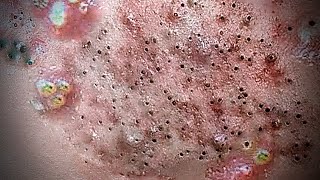 Relax Skincare Everyday with Acne Blackheads Treatment Spa 9731 [upl. by Nowyt]