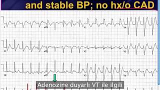 Amal Mattunun Haftalık EKG Vakası VT Bölüm II  Adenozin  2 Eylül 2013 [upl. by Gabriell]